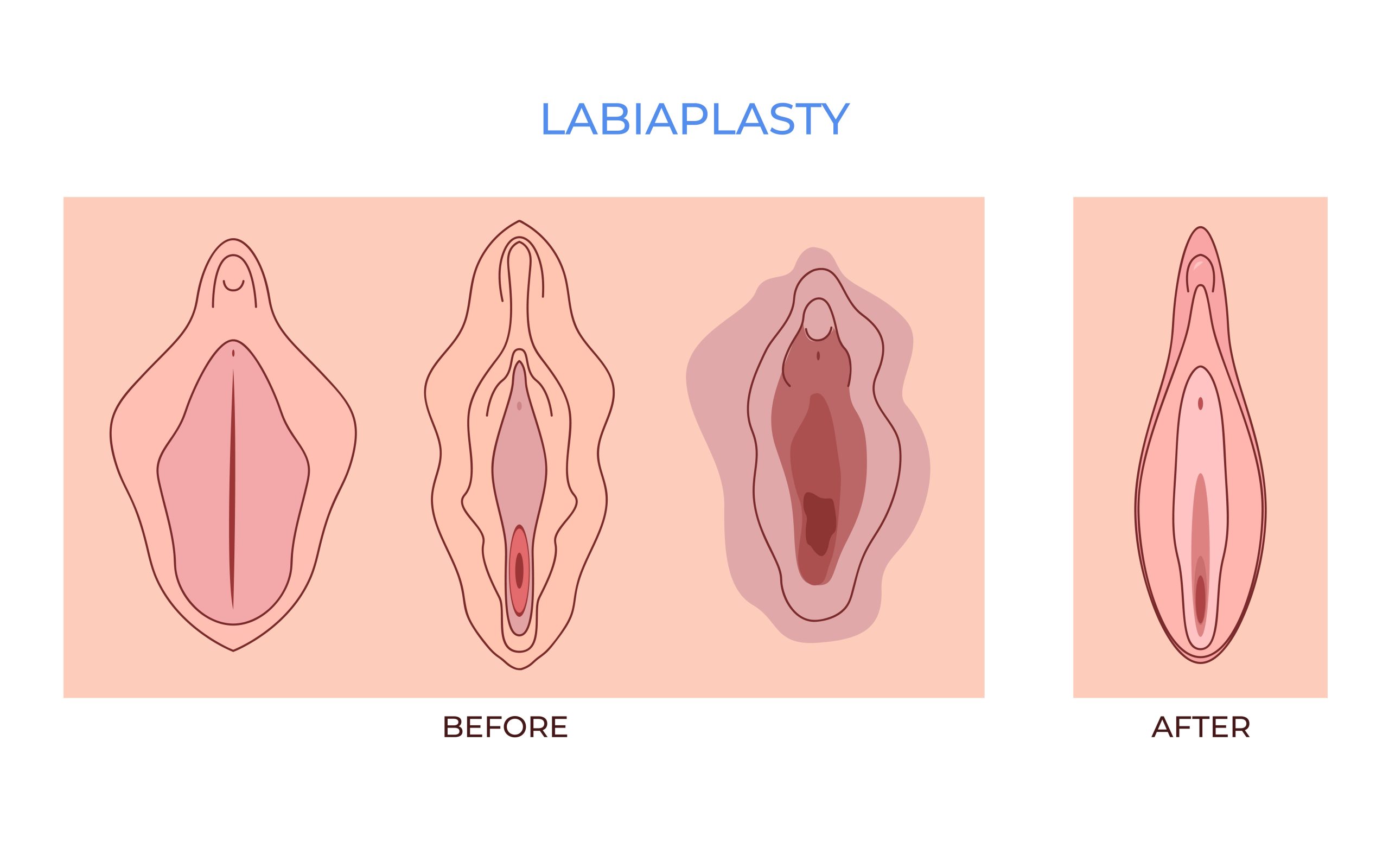Genital Estetik Çeşitleri